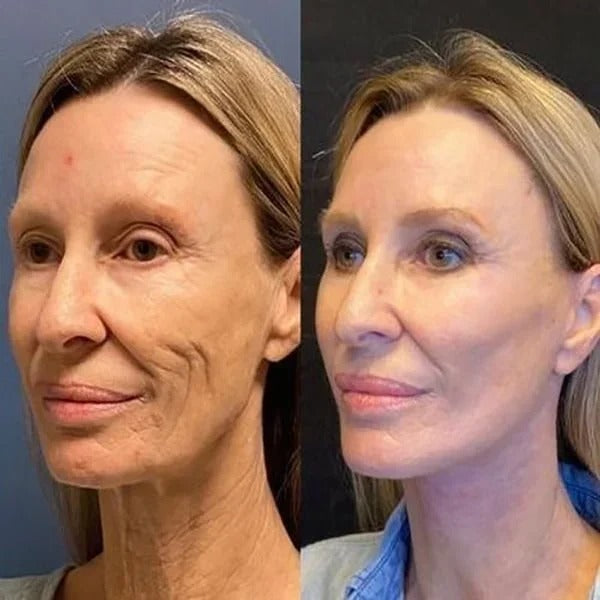 Serum med botulinumtoksin-lignende effekt, der glatter rynker og opstrammer huden.