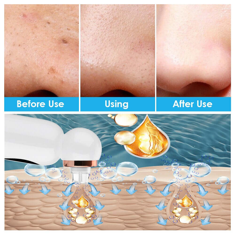 Ansigts Poresuger & Hydrodermabrasionsapparat