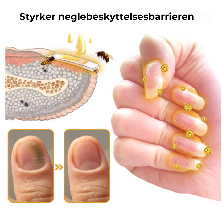 Resultat af neglesvamp behandling: Sunde, klare tånegle fri for svamp. Fodpleje serum.
