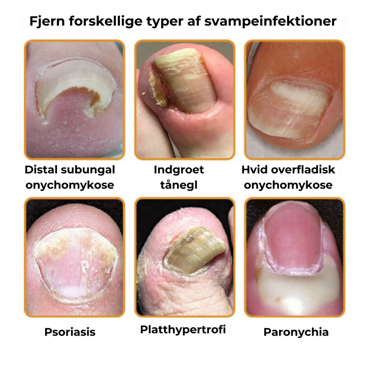 Påføring af neglesvamp behandling på tånegl. Understøtter sund vækst og forebygger svamp.