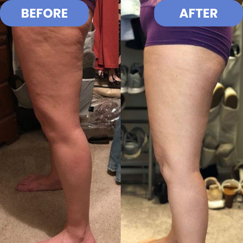 Infrarødt cellulite massageapparat for dybdegående hudpleje, opstramning og reduktion af strækmærker.