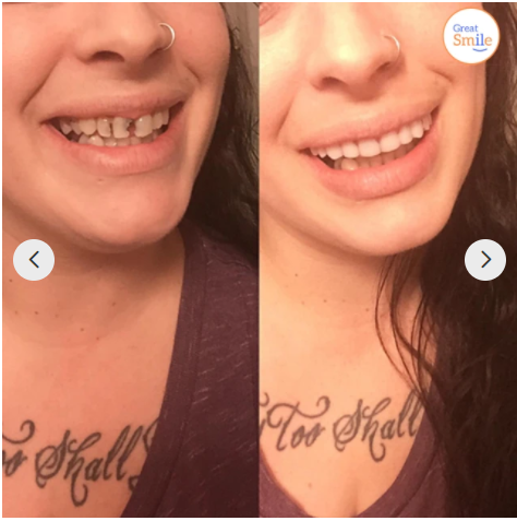 En smilende kvinde fremviser det aftagelige tandsæt; understreger den lette brug for et perfekt smil.