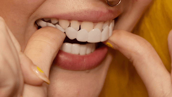 Øjeblikkelig Smilforvandling Facader for perfekte, hvidere tænder. Øg din selvtillid med et flot smil.