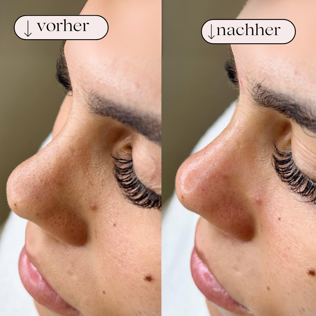 Avanceret hydrodermabrasion ansigtsrenser, der fjerner urenheder og renser porer effektivt.