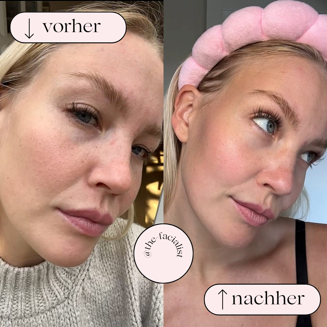 Hudpleje skønhedsapparat til dybderensning. Opnå en renere og friskere hud med hydrodermabrasion.