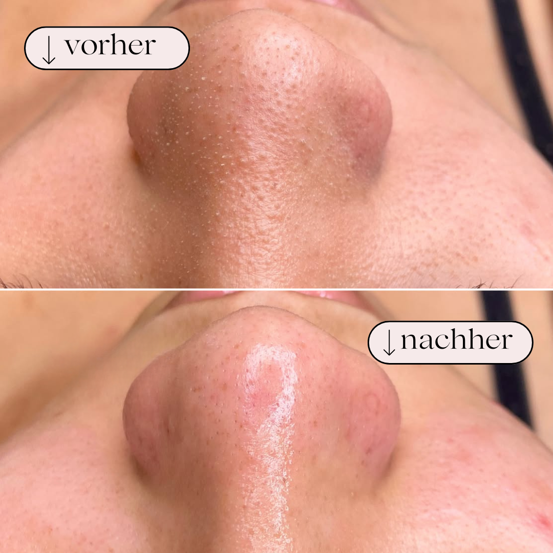 Effektiv ansigtsrenser med hydrodermabrasion. Perfekt til hjemmebehandling og dyb porerens.