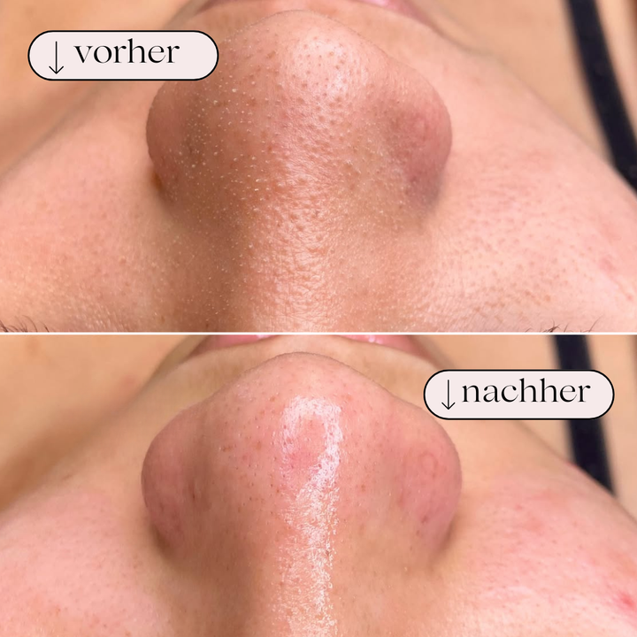Effektiv ansigtsrenser med hydrodermabrasion. Perfekt til hjemmebehandling og dyb porerens.