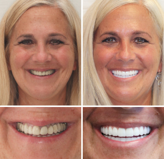 Genopdag glæden ved at smile med en komfortabel tandprotese til hjemmebrug. Giver naturligt look og selvtillid.