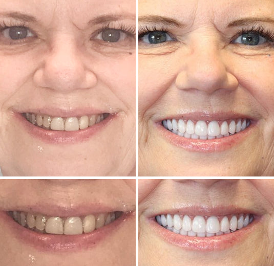 Individuelt tilpasset gebis for et naturligt, æstetisk smil og uovertruffen selvtillid. Dental protese komfort.