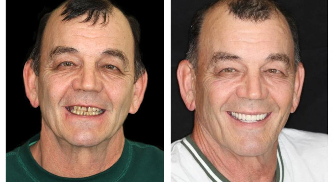Naturligt udseende tandprotese, der føles og ser ægte ud. Et komfortabelt gebis for et selvsikkert smil.